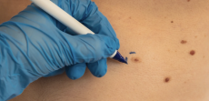 Skin Cancer Screening Appointment Near Fairfax, Virginia